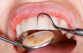 Teeth With Dental Tools — Naples, FL — Bradley Piotrowski, DDS, MSD, LLC