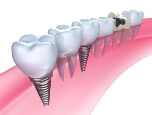 Graphic Dental Implants — Naples, FL — Bradley Piotrowski, DDS, MSD, LLC