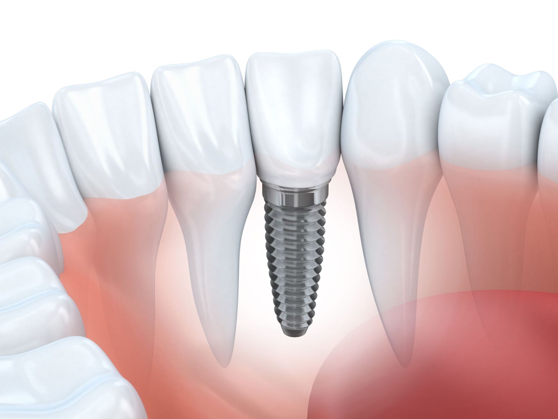 A computer generated image of a dental implant in a person 's mouth.