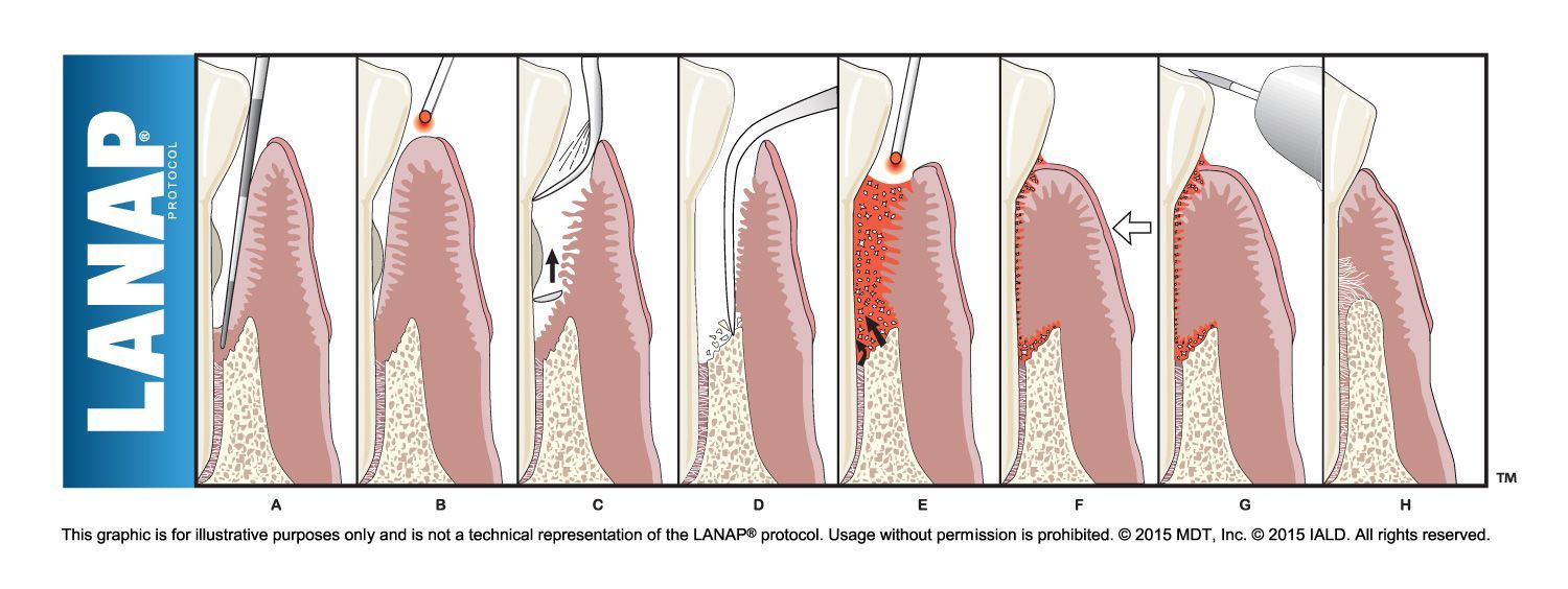 A diagram of a person 's teeth with the word lanap on the bottom