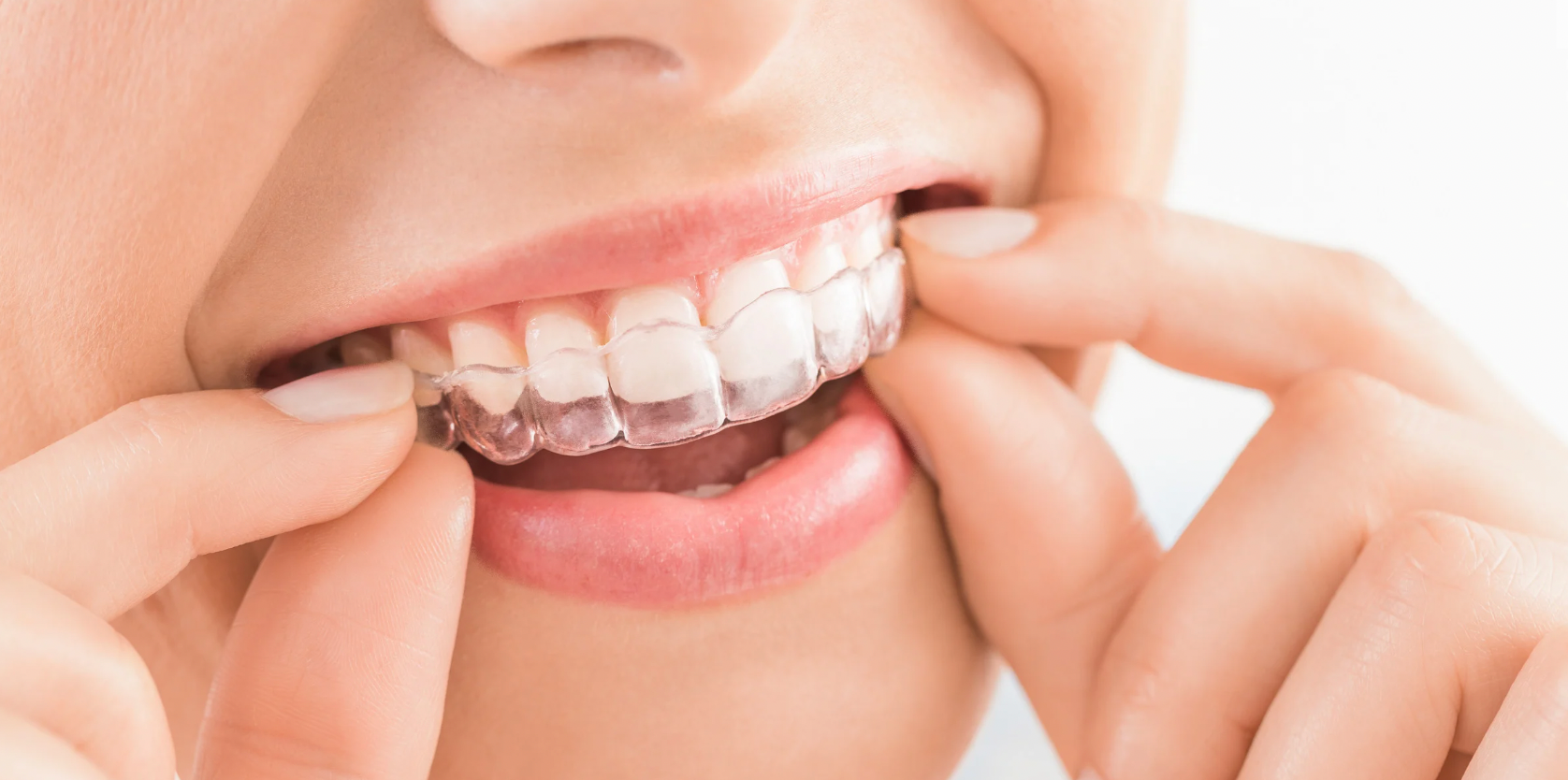 Invisalign for Teens vs. Adults: Is There a Difference in Treatment?