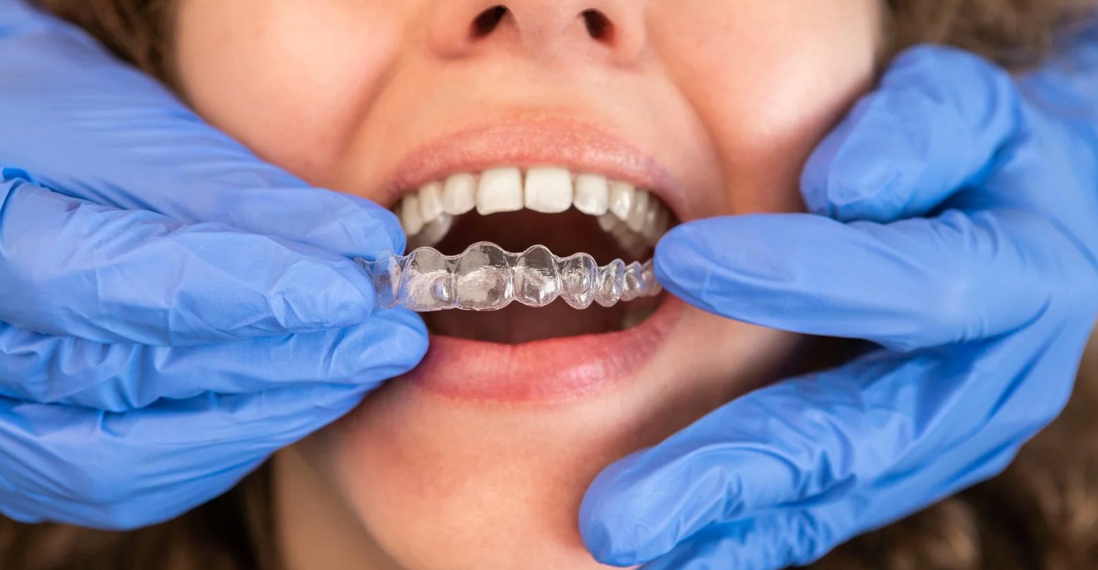 How to Care for Your Invisalign® Aligners: Dos and Don’ts