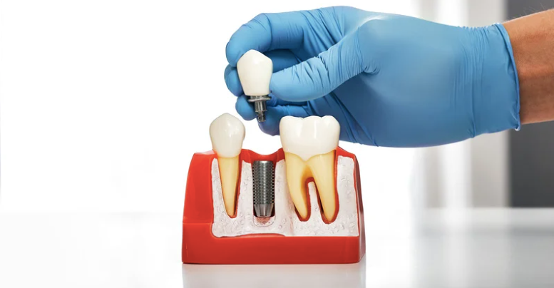 Why Do Dental Implants Fail? Top Causes and How to Prevent It