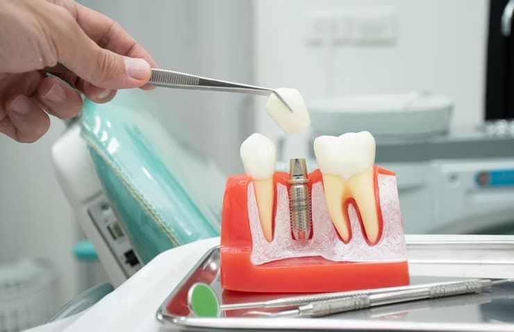 dental implant in Mason