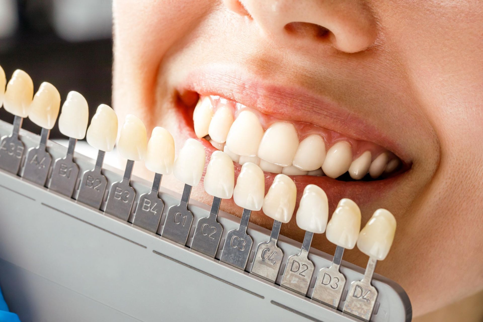 A person holds a dental shade guide next to their teeth to compare the color of their smile for a cosmetic procedure.