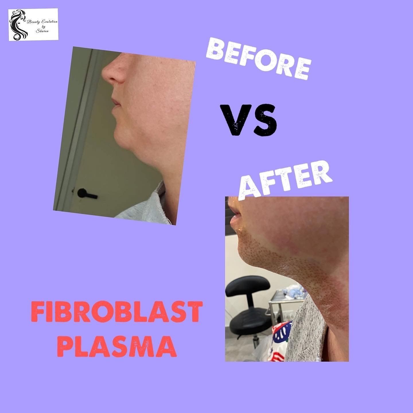 Fibroblast treatments by Beauty Evolution by Sharon