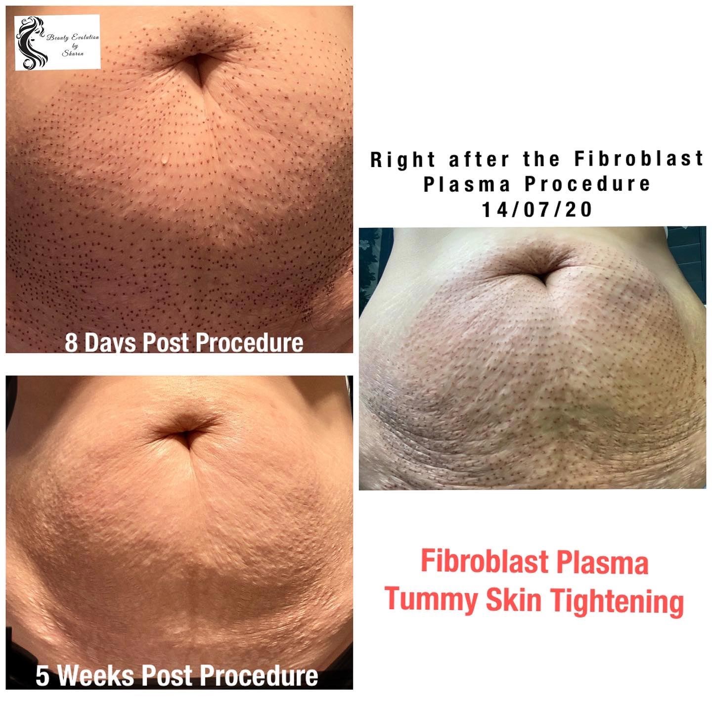 Fibroblast treatments by Beauty Evolution by Sharon