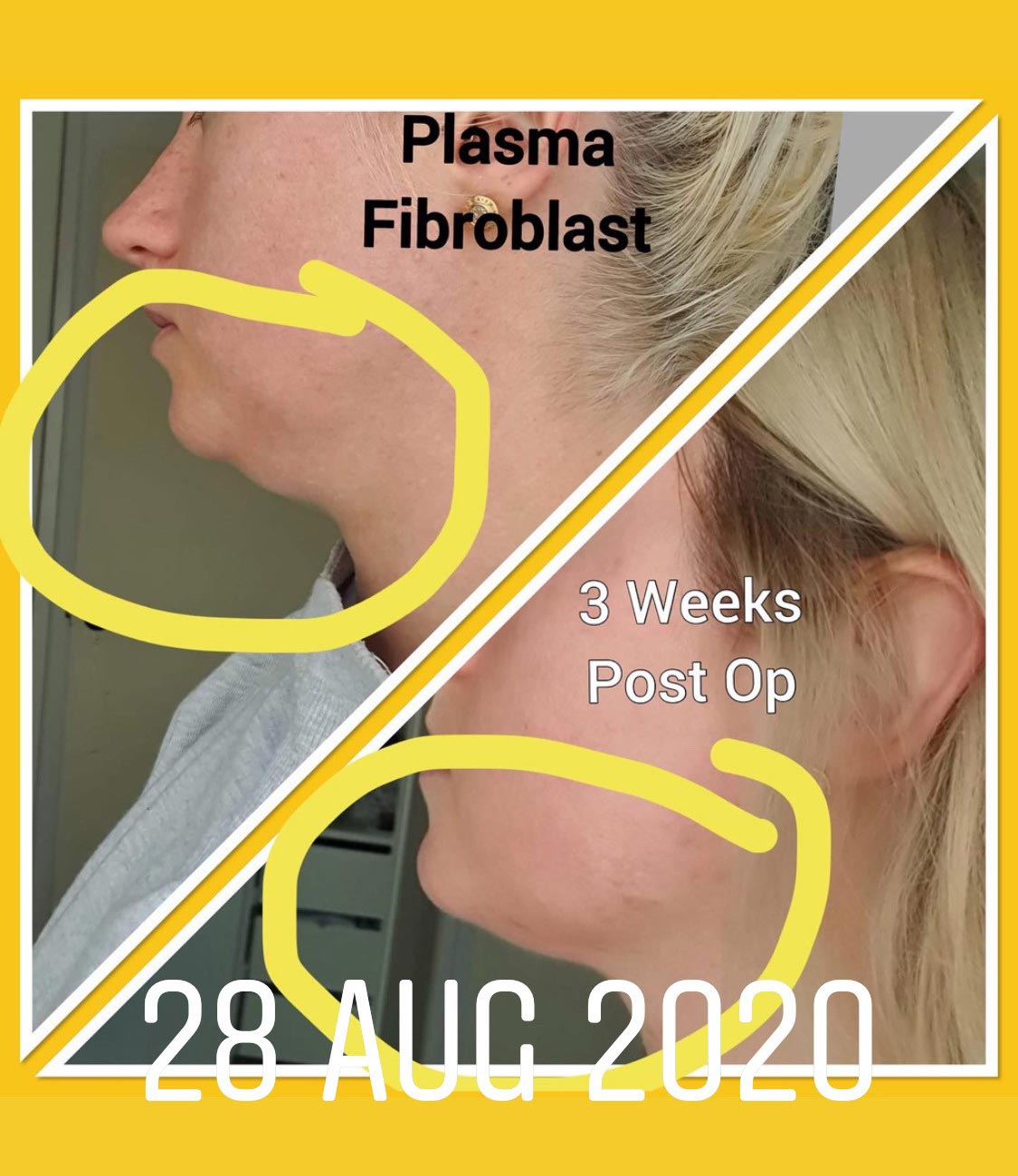 Fibroblast treatments by Beauty Evolution by Sharon