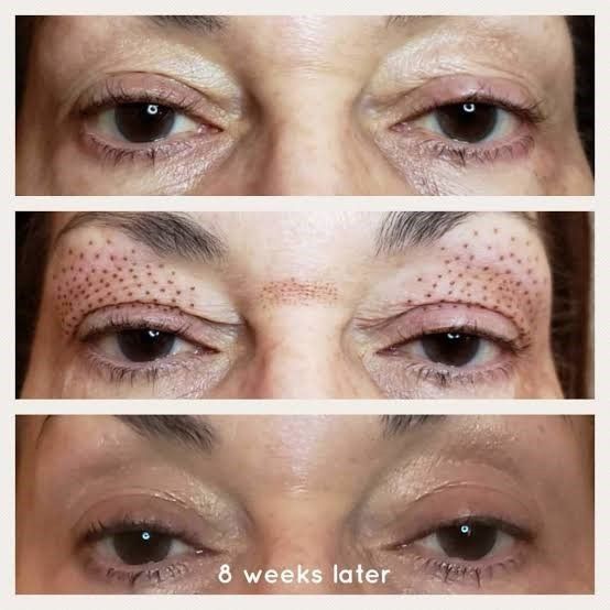 Fibroblast treatments by Beauty Evolution by Sharon