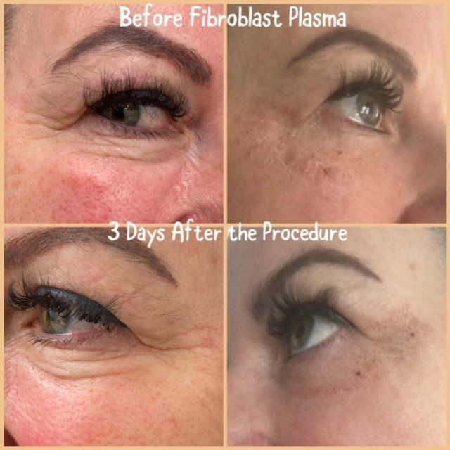 Fibroblast treatments by Beauty Evolution by Sharon