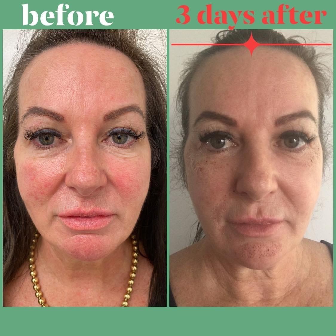Fibroblast treatments by Beauty Evolution by Sharon