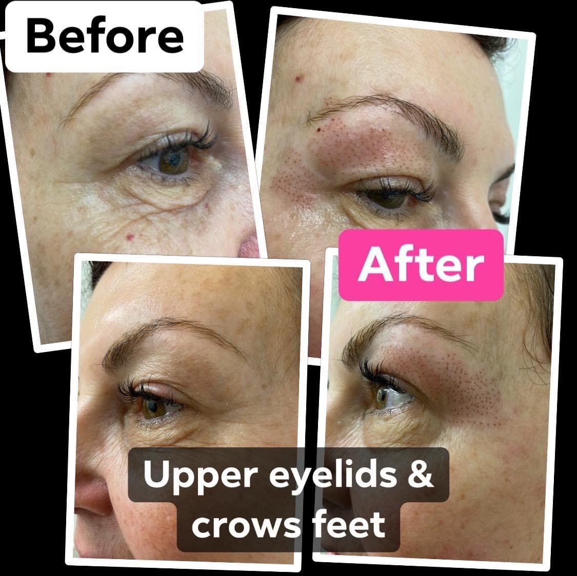 Fibroblast treatments by Beauty Evolution by Sharon