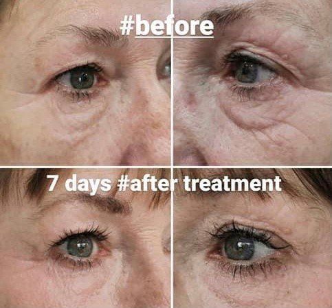 Fibroblast treatments by Beauty Evolution by Sharon