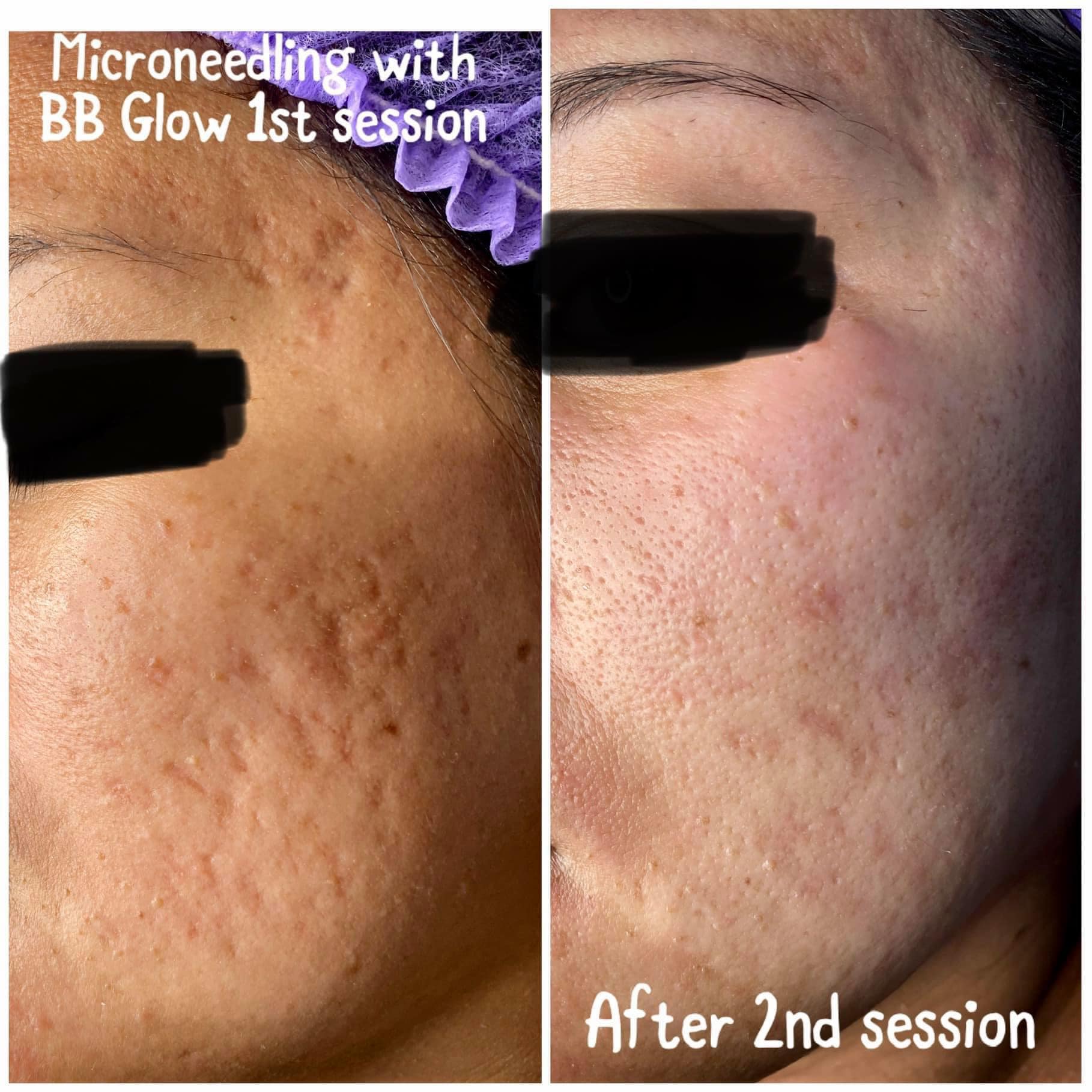 Fibroblast treatments by Beauty Evolution by Sharon