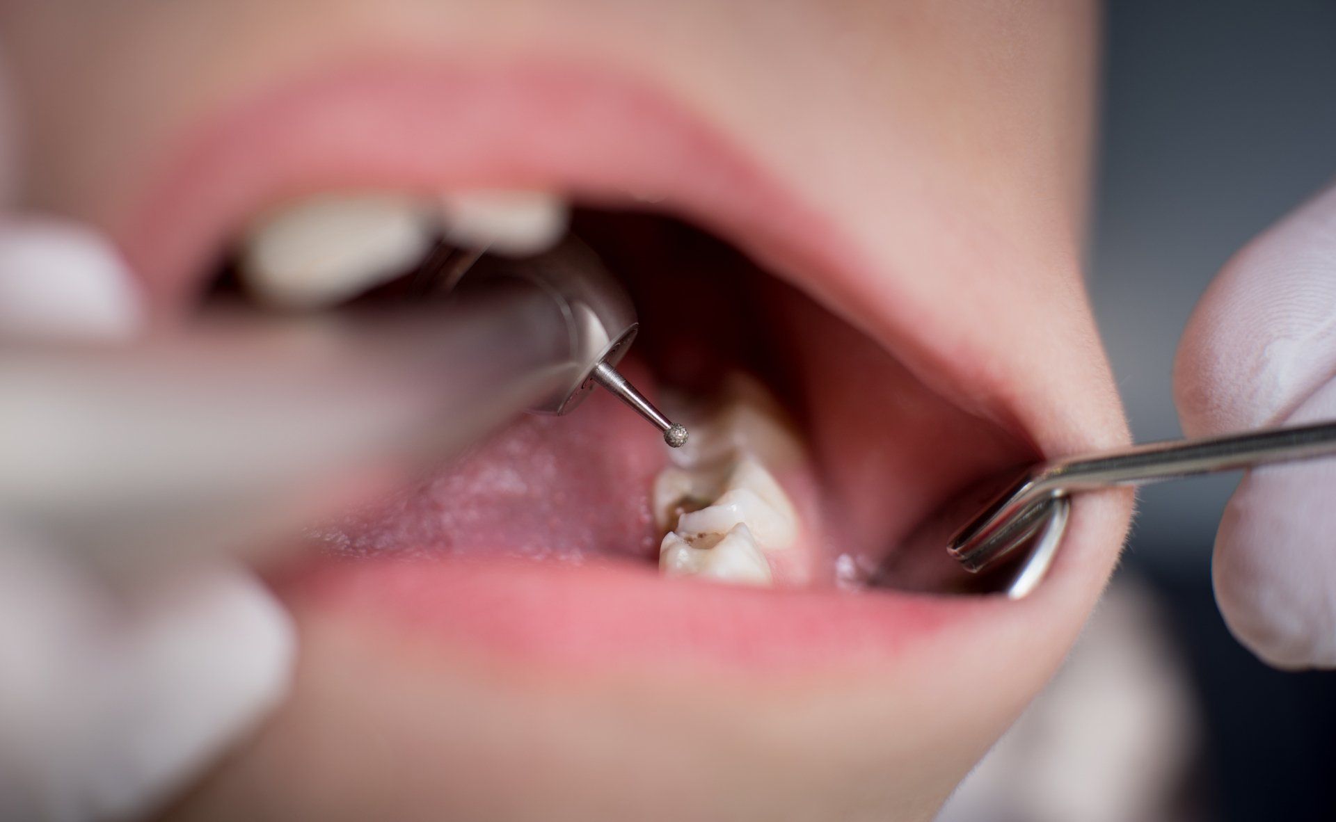 Cavity Fillings in Buffalo, NY