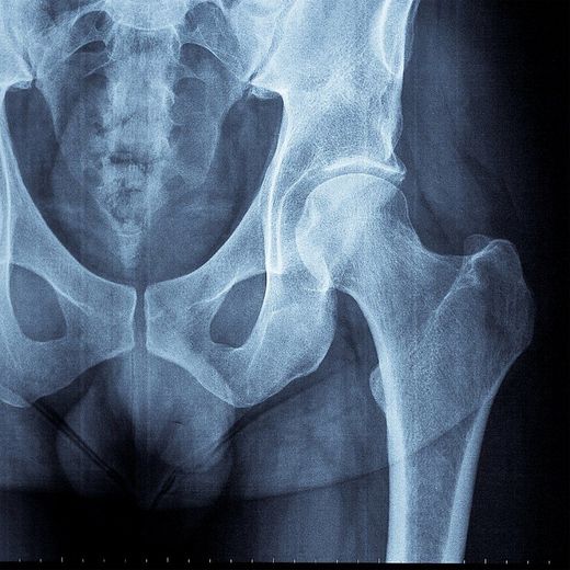 radiografia anca
