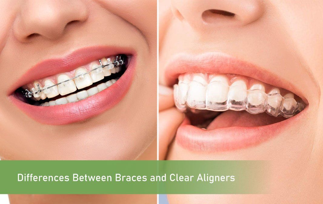 Differences Between Braces and Clear Aligners