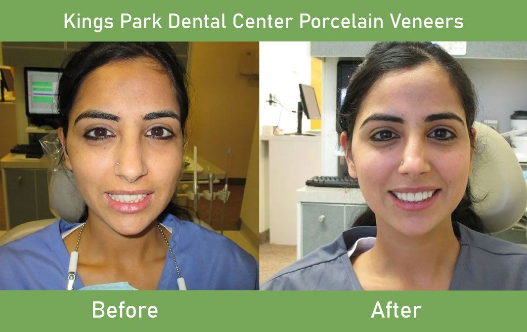 Kings Park Dental Center before and after Porcelain Veneers