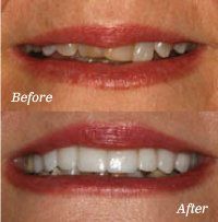 Benefits of Teeth Crowns