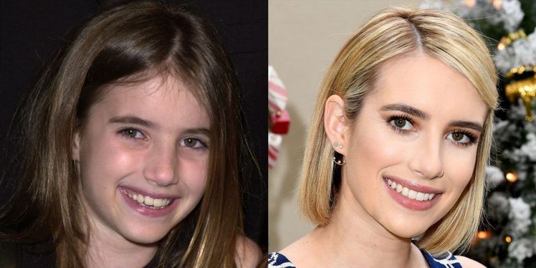 Emma Watson before and after Porcelain Veneers