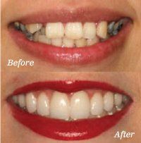 Before and after Dental Bridges