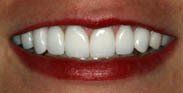 After Teeth Whitening Procedure