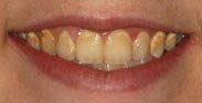 Before Teeth Whitening Procedure