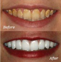 Teeth Whitening 960w 