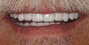 After Veneers