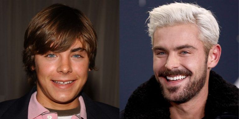 Zac Efron before and after Porcelain Veneers