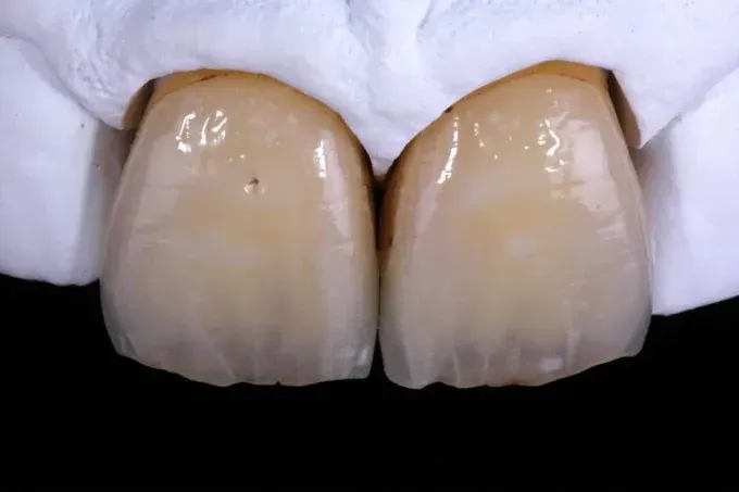 sbiancamento dentale