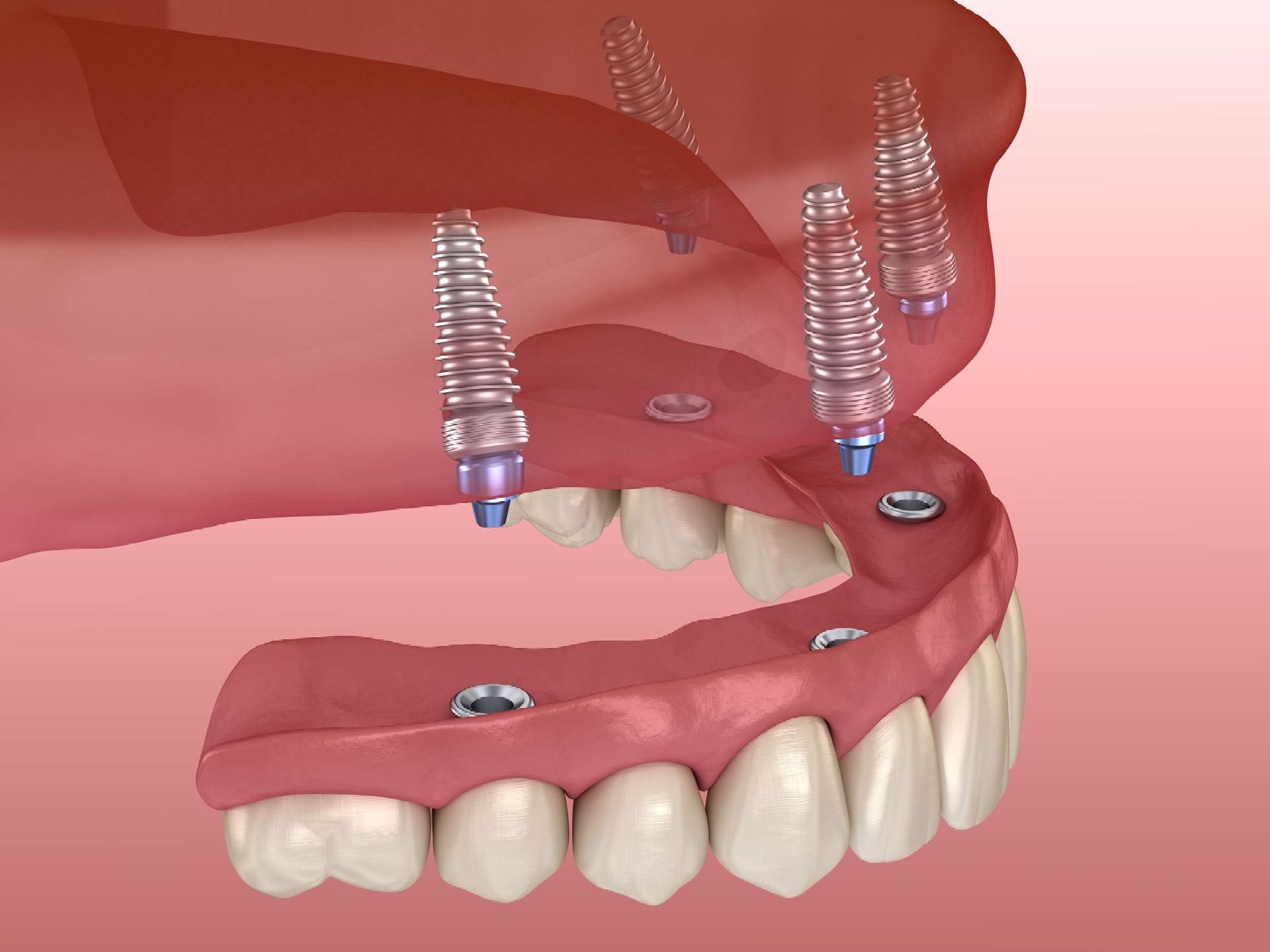 All-on-x implant