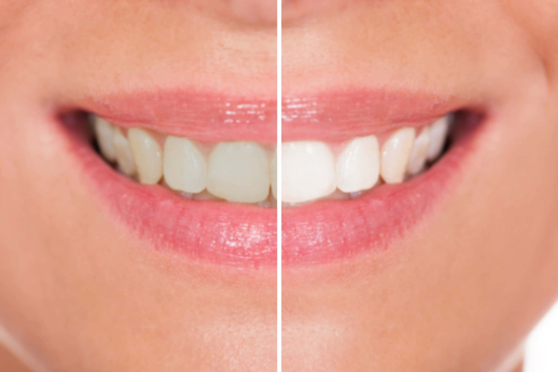 Before and After Teeth Whitening - Dentist in Grayslake, IL
