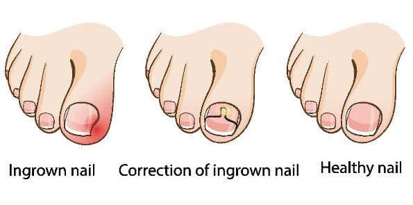 Update 135+ why nails grow downward latest