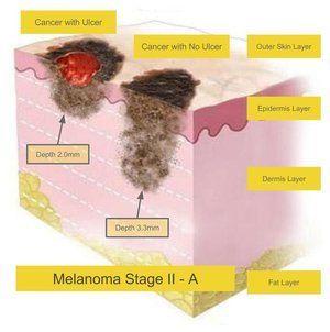 Melanoma Stage A