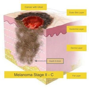 Melanoma Stage C