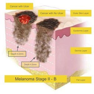 Melanoma Stage B