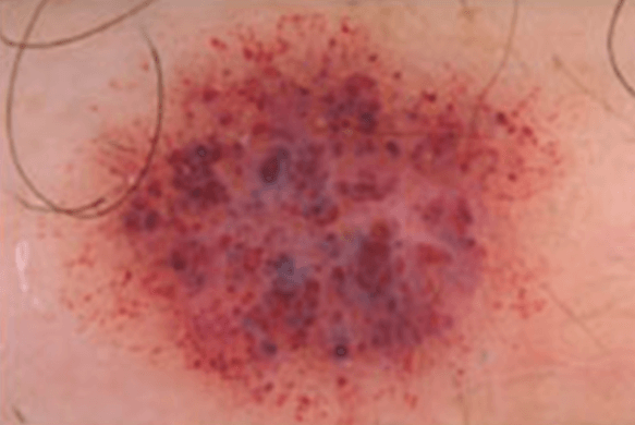 A close up of a red spot on a person 's skin.