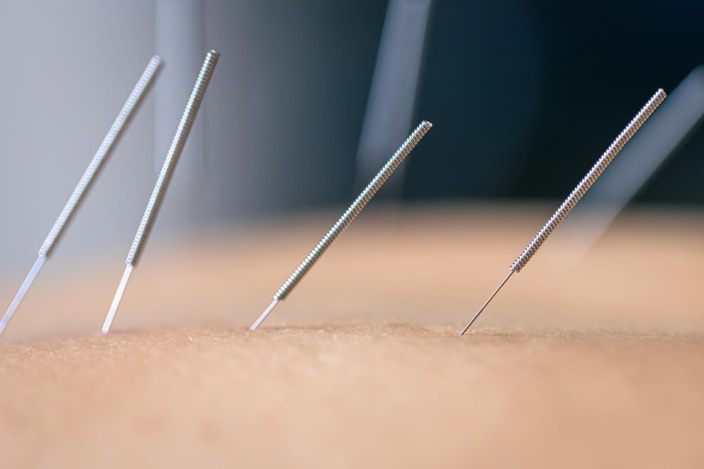 A person is getting acupuncture needles inserted into their skin.