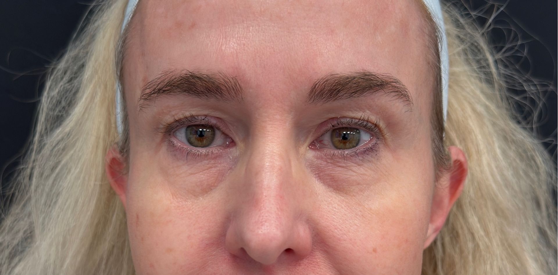 A close up of a woman 's eyes with a nose ring after blepharoplasty surgery