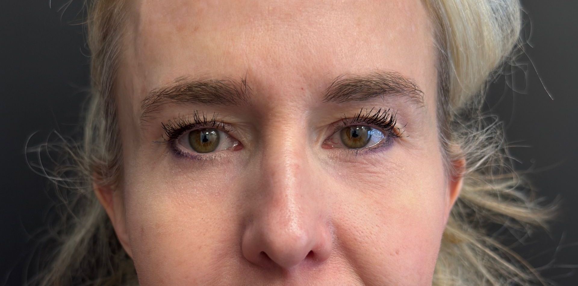 Real Patient Before and After Blepharoplasty at Clearview Dermatology