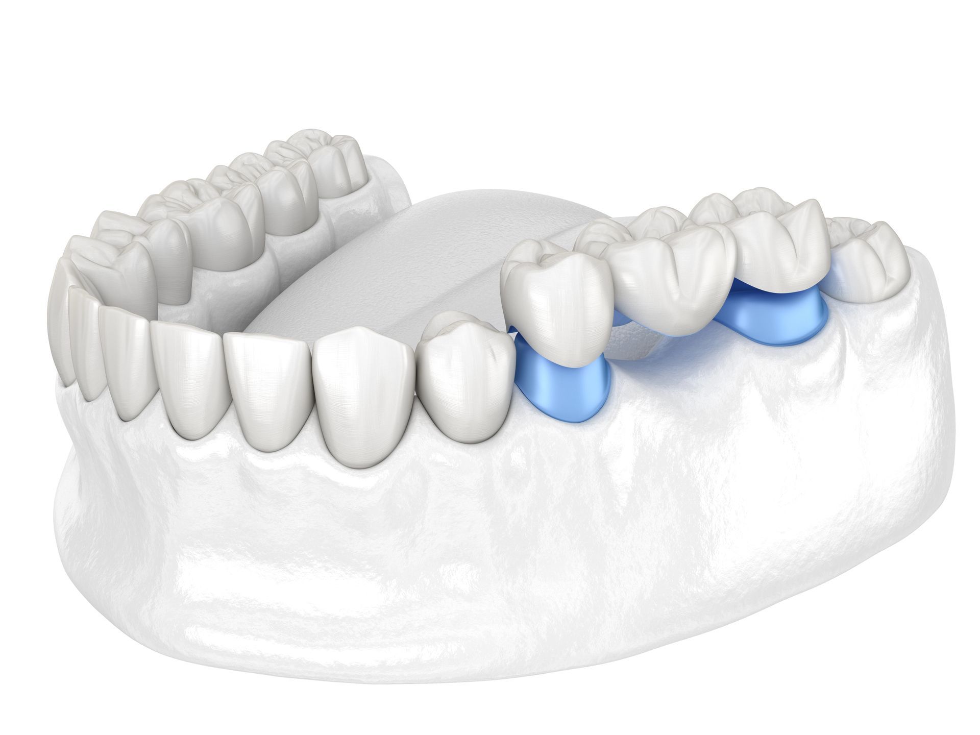 Modelo de puente dental que muestra tres dientes conectados en una boca, dos dientes de soporte son azules.