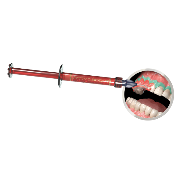 Opalescence Boost c/barrera Opaldam kit Consultorio al 40% blanqueamiento