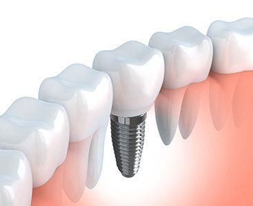 chris dennien dental implant of dental