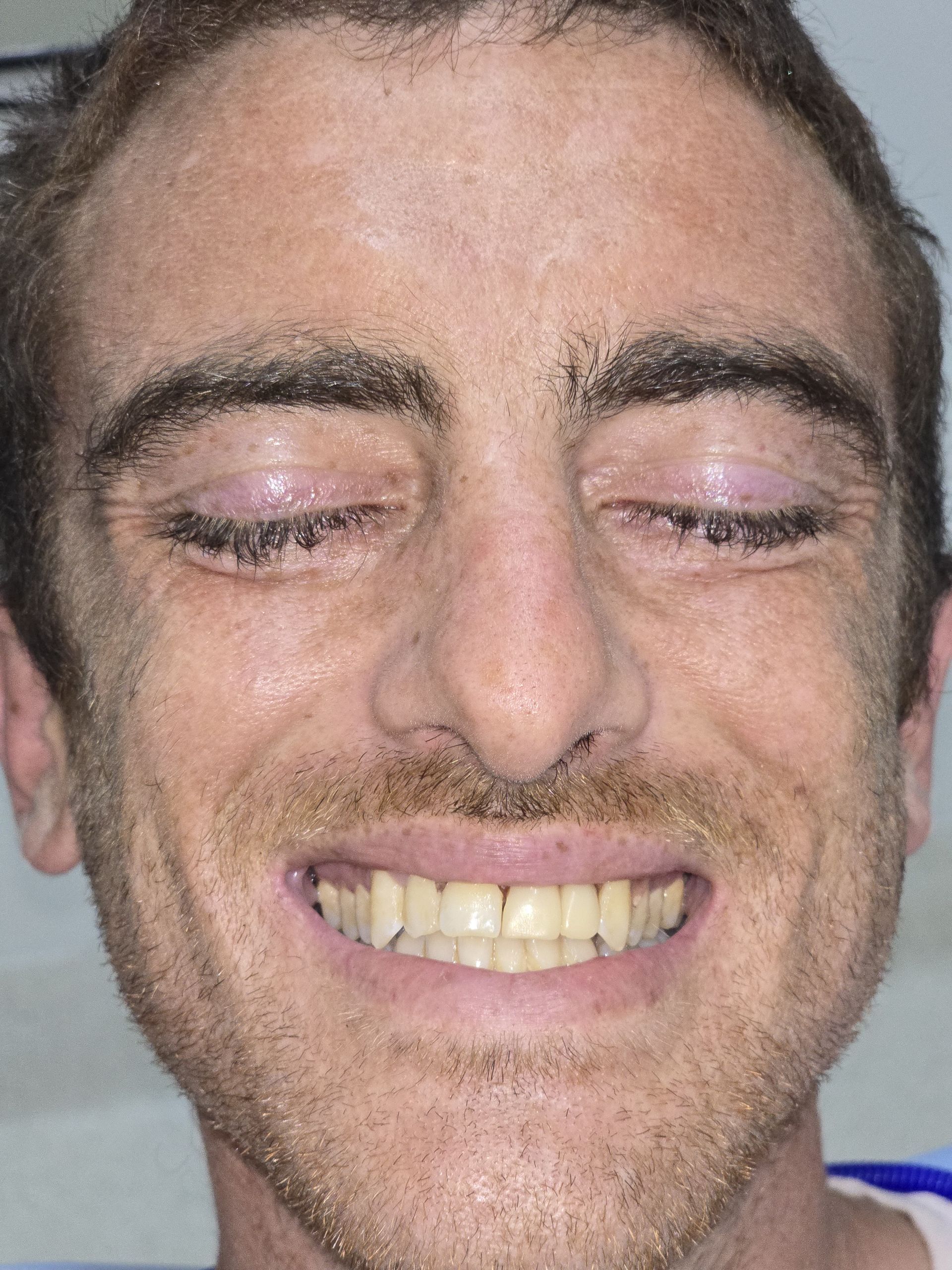 Before and after of Denture Treatment — Full & Partial Dentures in Newcastle, NSW