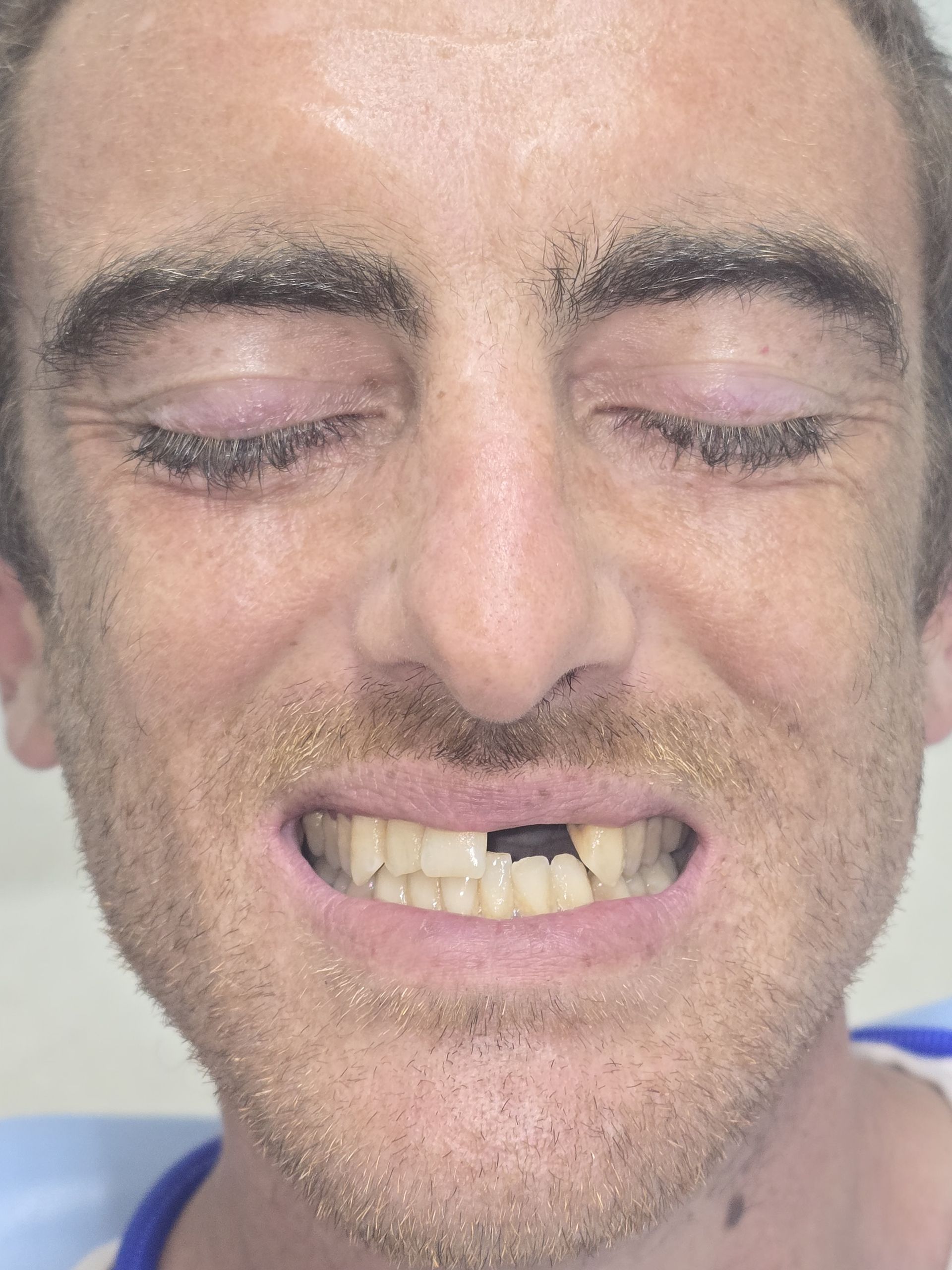 Before and after of Denture Treatment — Full & Partial Dentures in Newcastle, NSW