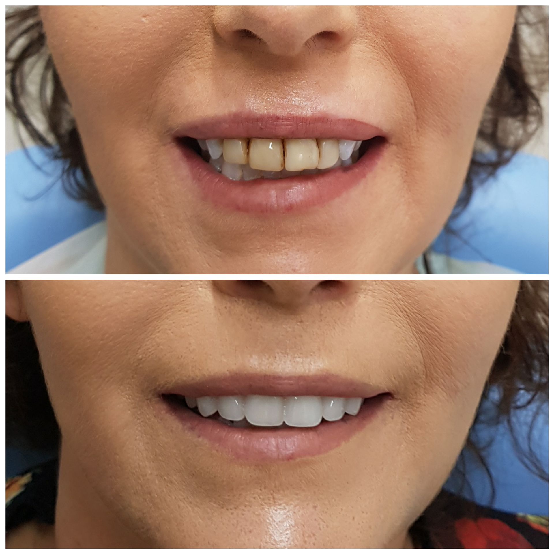 Before and After Denture Treatment — Denture Services in Newcastle, NSW