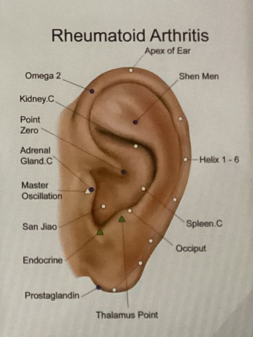 A diagram of a person 's ear for rheumatoid arthritis