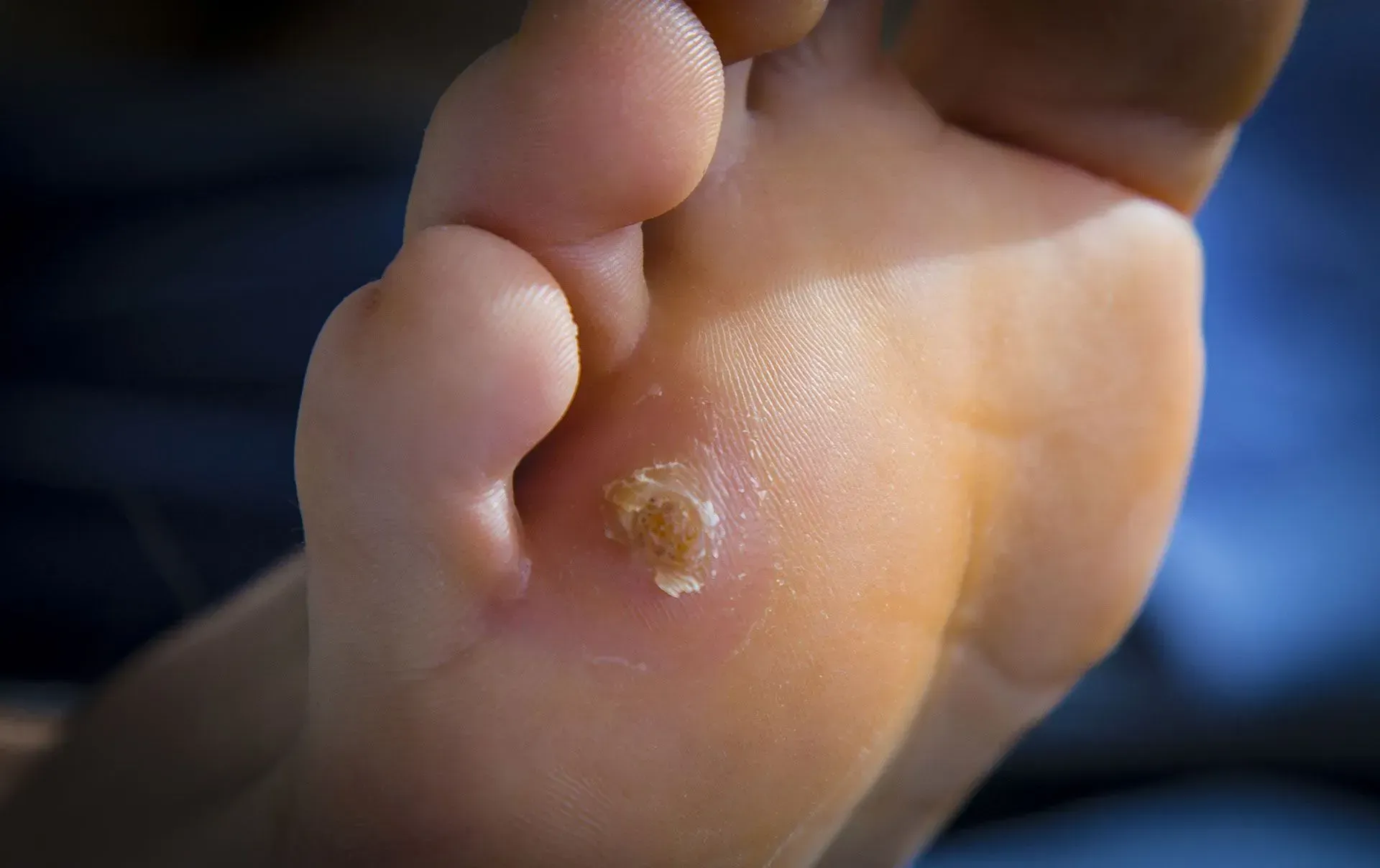 Foot with a wart on the sole; a tan, raised growth surrounded by light-colored skin.