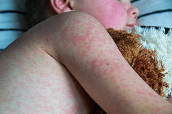 Measles